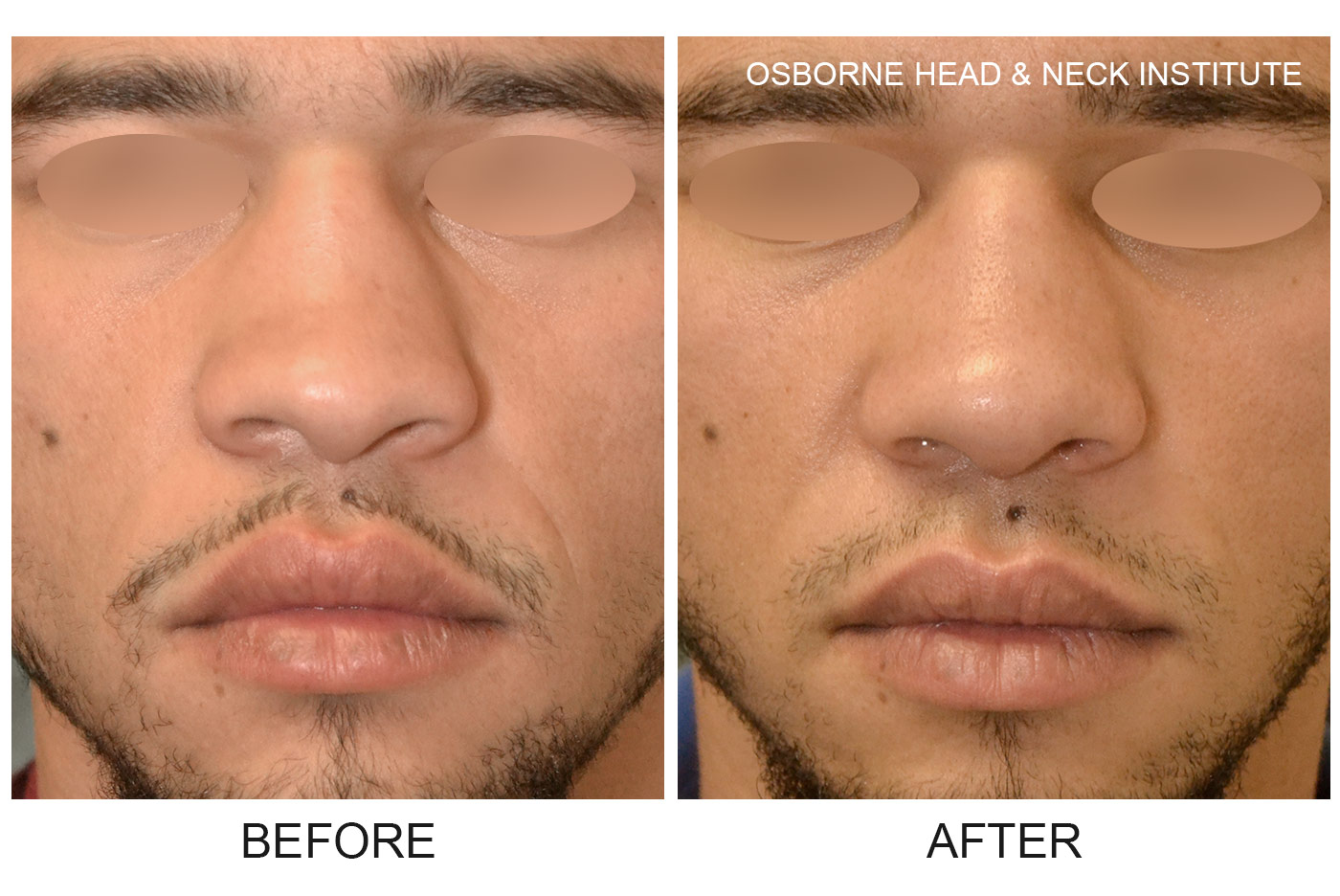 Before & After Rhinoplasty Photos Rhinoplasty & Nose Surgery
