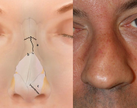 nasal fracture surgery