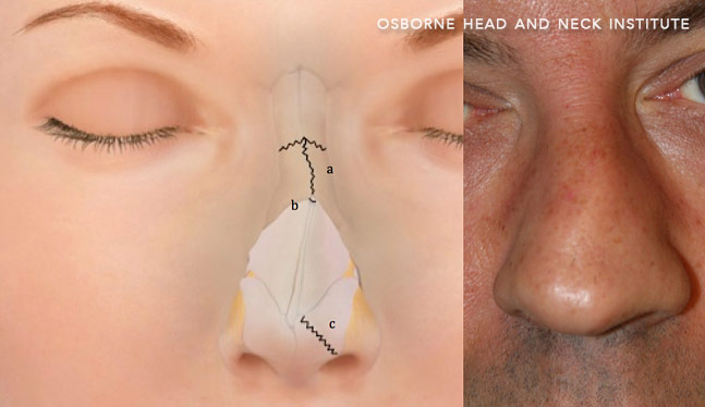 nasal trauma surgery treatment