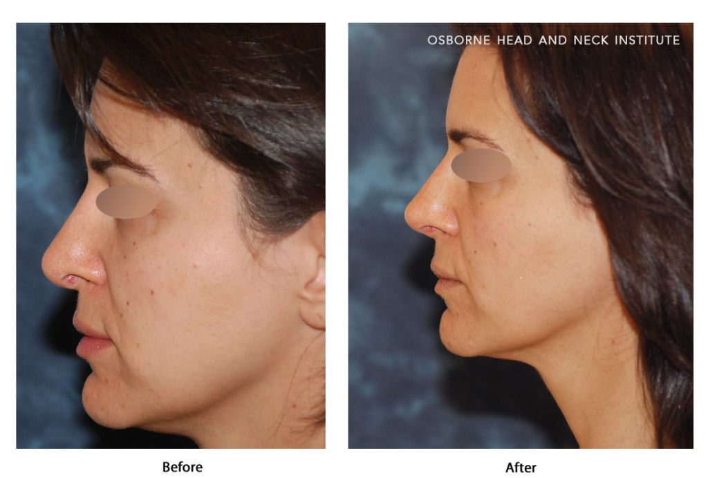 nose surgery los angeles