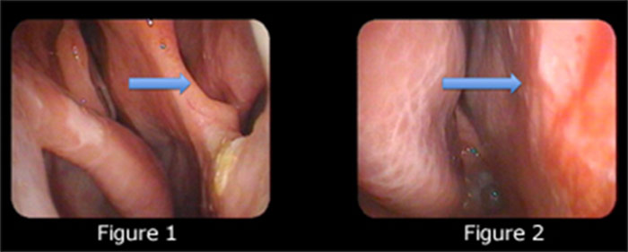 septal perforation treatment